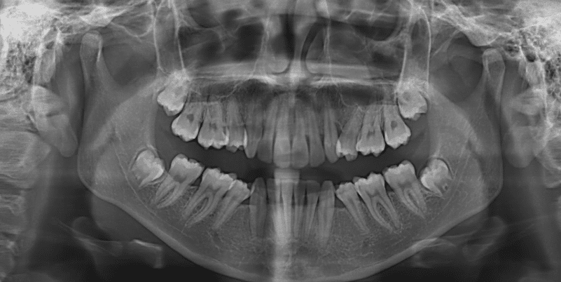 Invisalign scanner in Bangalore